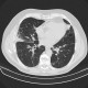 Atypical pneumonia, influenza, H1N1, 10 months after: CT - Computed tomography